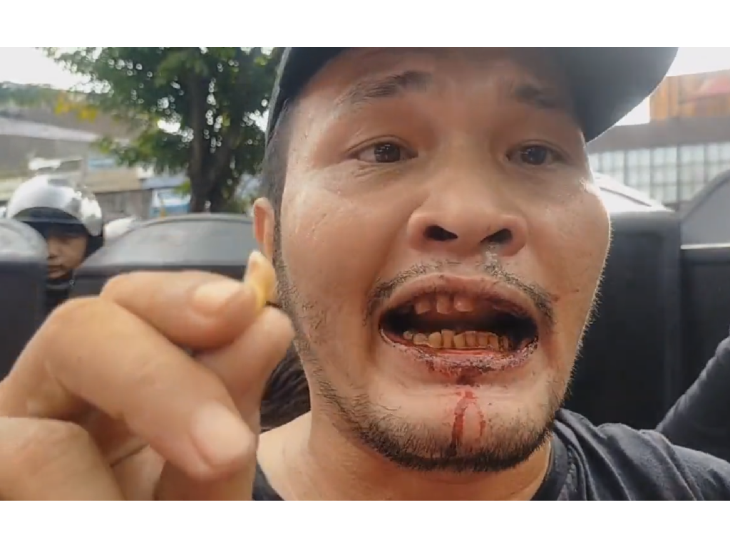 Gigi Patah Mulut Berdarah, Nicho Silalahi Mengaku Dipukuli Polisi