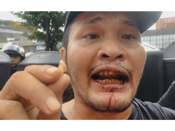 Gigi Patah Mulut Berdarah, Nicho Silalahi Mengaku Dipukuli Polisi