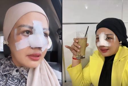 Agar terlihat cantik, Elly Sugigi operasi hidung. (Foto: Instagram/Elly Sugigi)