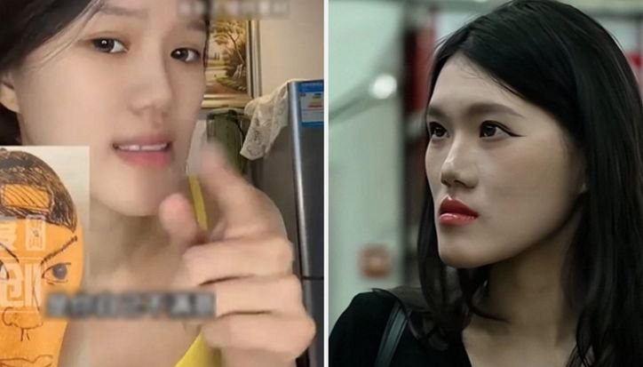 Niat Koreksi Rahang 2 Milimeter, Wanita 24 Tahun Malah Alami Perubahan Wajah hingga 13 Milimeter Victim A